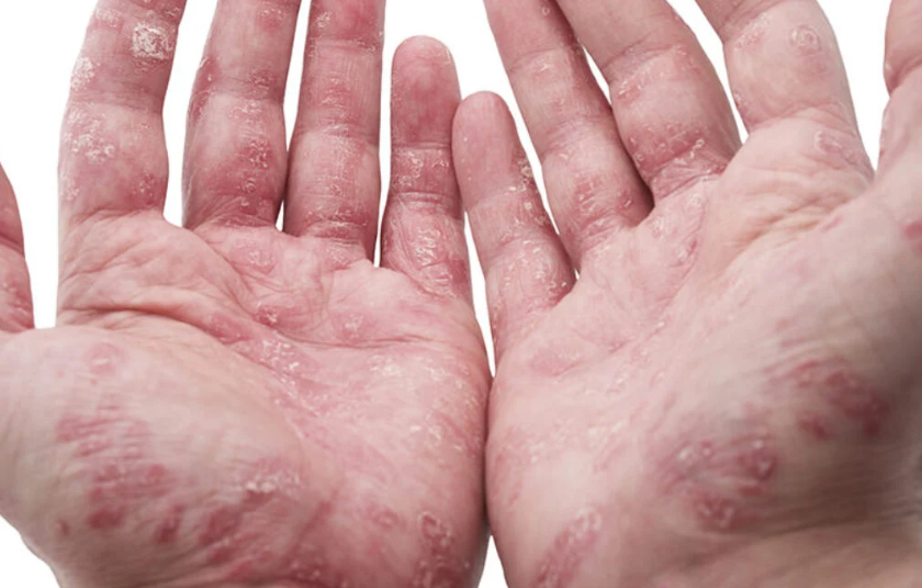 Systemic Impact of Psoriatic Arthritis: From the Lungs to Connective Tissues